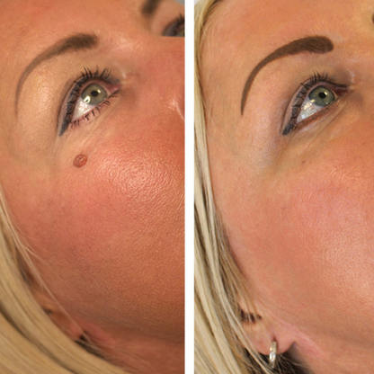 Lumia Clear | ערכת הסרת נקודות חן