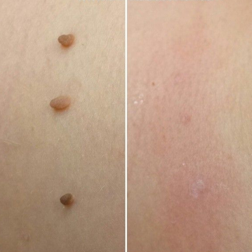 Lumia Clear | ערכת הסרת נקודות חן