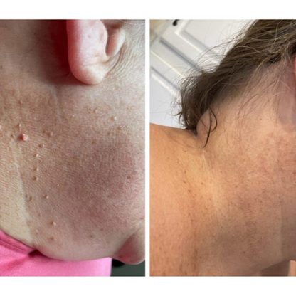 Lumia Clear | ערכת הסרת נקודות חן