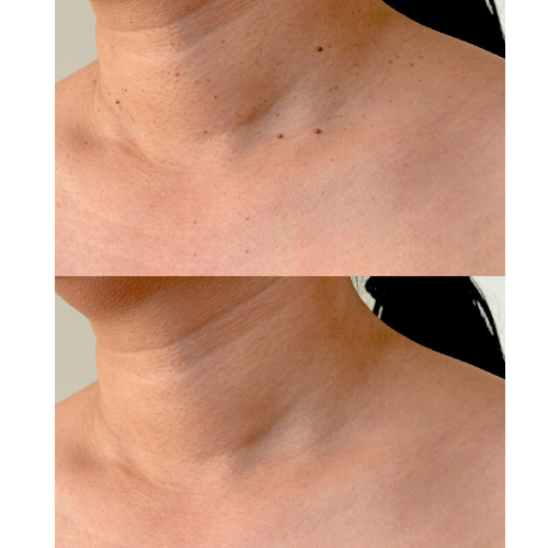 Lumia Clear | ערכת הסרת נקודות חן