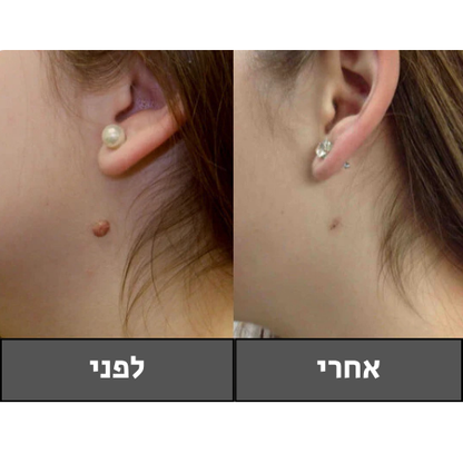 Lumia Clear | ערכת הסרת נקודות חן