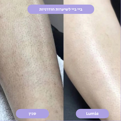 מסיר השיער הקריסטלי של Lumia