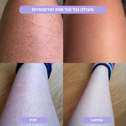 מסיר השיער הקריסטלי של Lumia